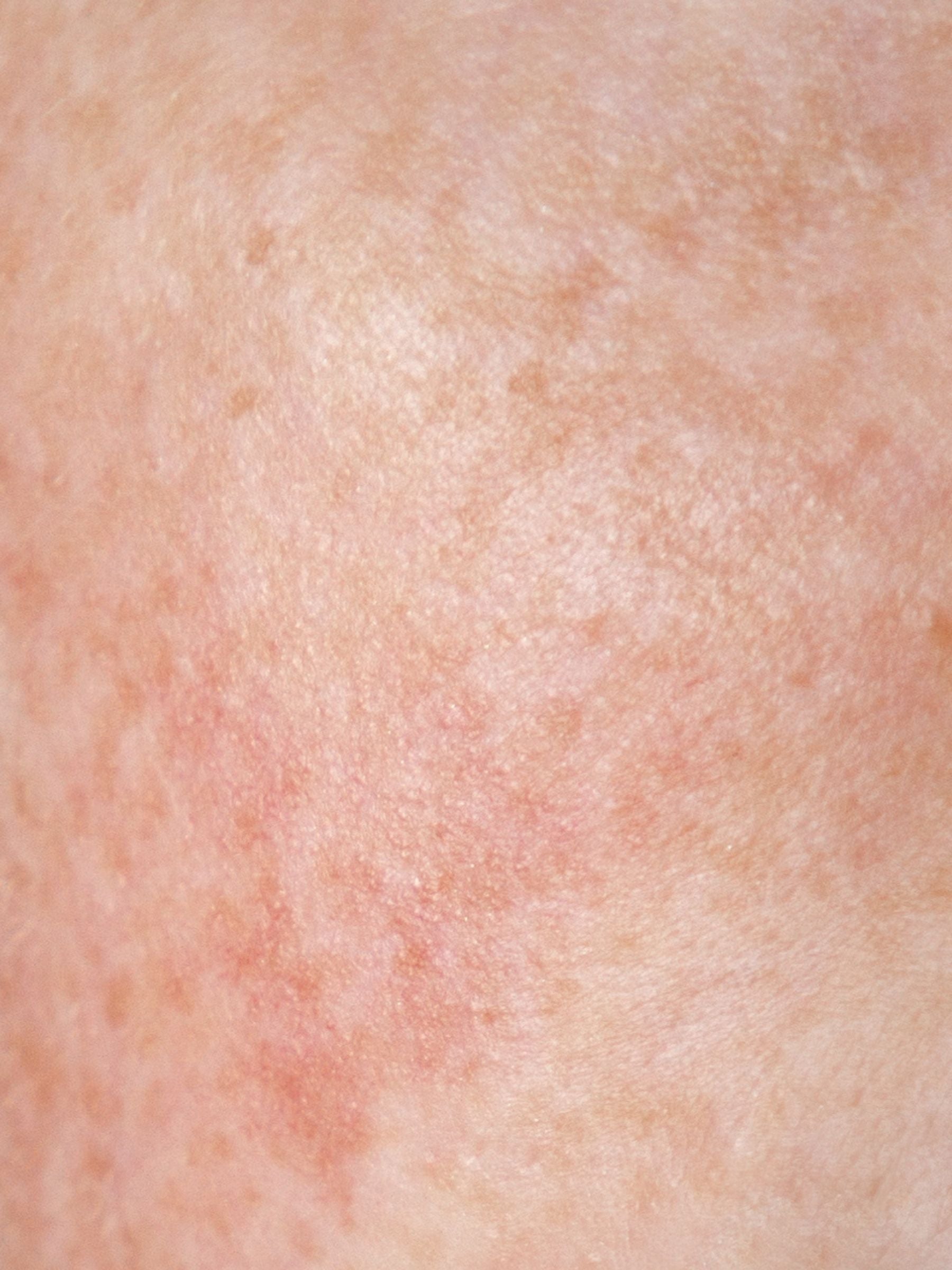 sensitive & reactive skin